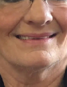 Before image for Melissa Turner