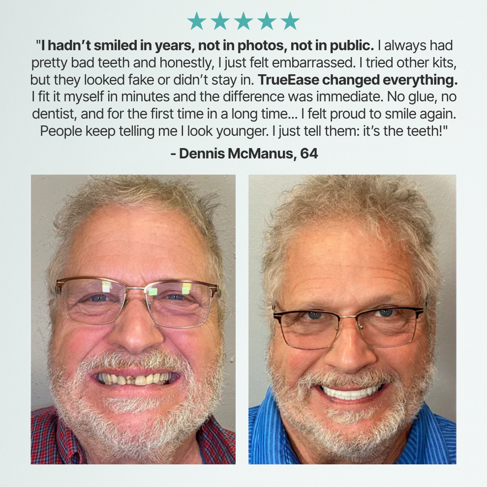 SmileFit™ Custom-Fit Full Functional Dentures