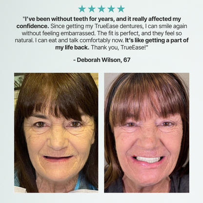 SmileFit™ Custom-Fit Full Functional Dentures